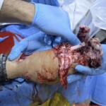 Foot crushed in meat grinder