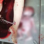 Forensic autopsy of pregnant woman