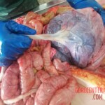 Forensic autopsy of pregnant woman