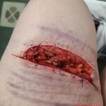 Hardcore self-harm collection