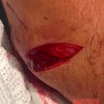 Homophobic machete attack in Australia