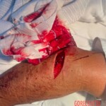 Homophobic machete attack in Australia