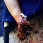 Russian soldier who stepped on mine in Afghanistan