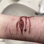 Self-harm
