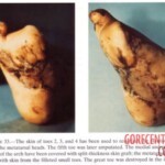 Vietnam War foot injuries