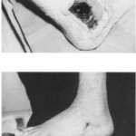 Vietnam War foot injuries
