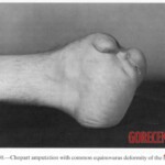 Vietnam War foot injuries