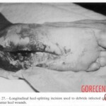 Vietnam War foot injuries