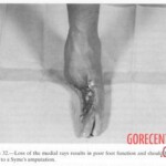 Vietnam War foot injuries