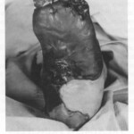 Vietnam War foot injuries