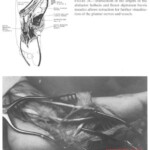 Vietnam War foot injuries