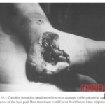Vietnam War foot injuries