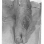 Vietnam War foot injuries