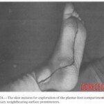 Vietnam War foot injuries