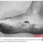 Vietnam War foot injuries