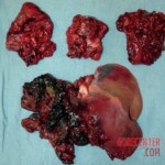 Man committed suicide with explosive