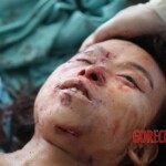 Post-mortem examination of female car accident victim