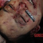 Post-mortem examination of female car accident victim