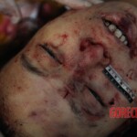 Post-mortem examination of female car accident victim