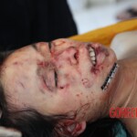 Post-mortem examination of female car accident victim