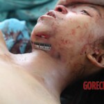 Post-mortem examination of female car accident victim