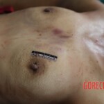 Post-mortem examination of female car accident victim