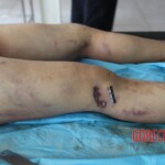 Post-mortem examination of female car accident victim