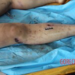 Post-mortem examination of female car accident victim