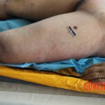 Post-mortem examination of female car accident victim