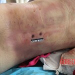 Post-mortem examination of female car accident victim