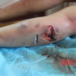 Post-mortem examination of female car accident victim