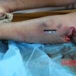 Post-mortem examination of female car accident victim