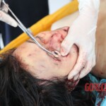 Post-mortem examination of female car accident victim