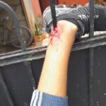 Young thief has his ankle pierced through fence