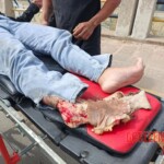 Young woman's leg is crushed by concrete mixer truck