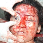 Examination of female suicidal jumper