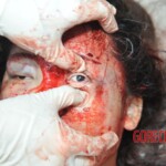 Examination of female suicidal jumper