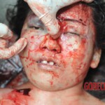 Examination of female suicidal jumper