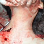 Examination of female suicidal jumper