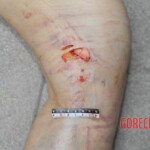 Examination of female suicidal jumper