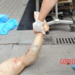 Examination of female suicidal jumper