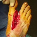 Foot cut by rope in boat accident