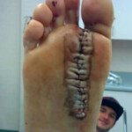 Foot cut by rope in boat accident