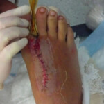 Foot cut by rope in boat accident