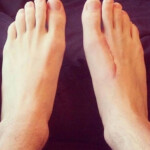 Foot cut by rope in boat accident