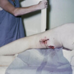Vietnam war injury