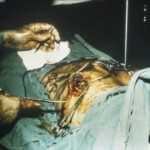 Vietnam war injury
