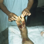 Vietnam war injury