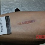 Murdered and stuffed in suitcase