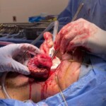 Surgical removal of jaw due to carcinoma under tongue